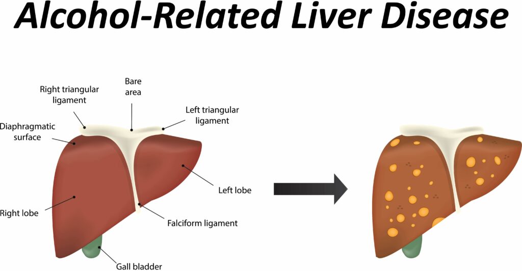 Alcohol-related Liver Disease