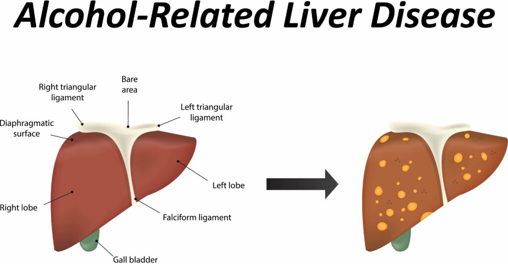 Alcohol-related Liver Disease – Doctall Living