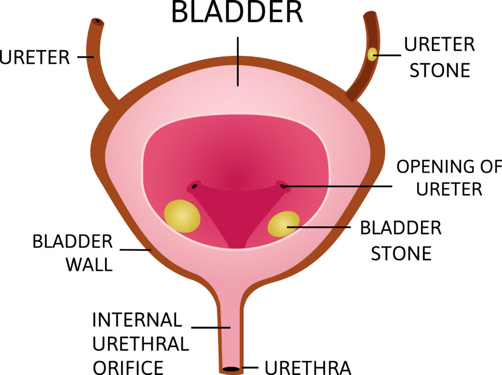 Bladder Stones