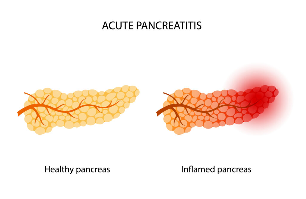 Acute Pancreatitis