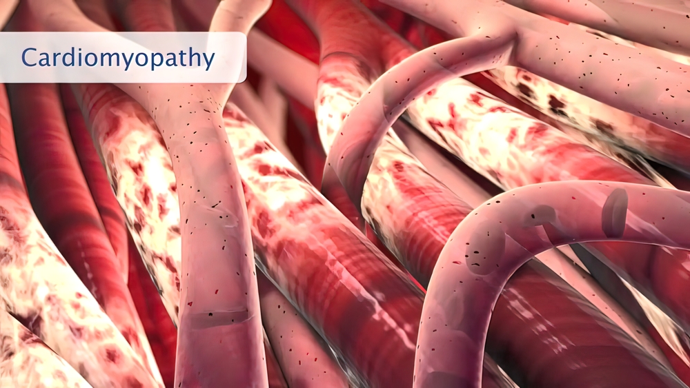 Cardiomyopathy