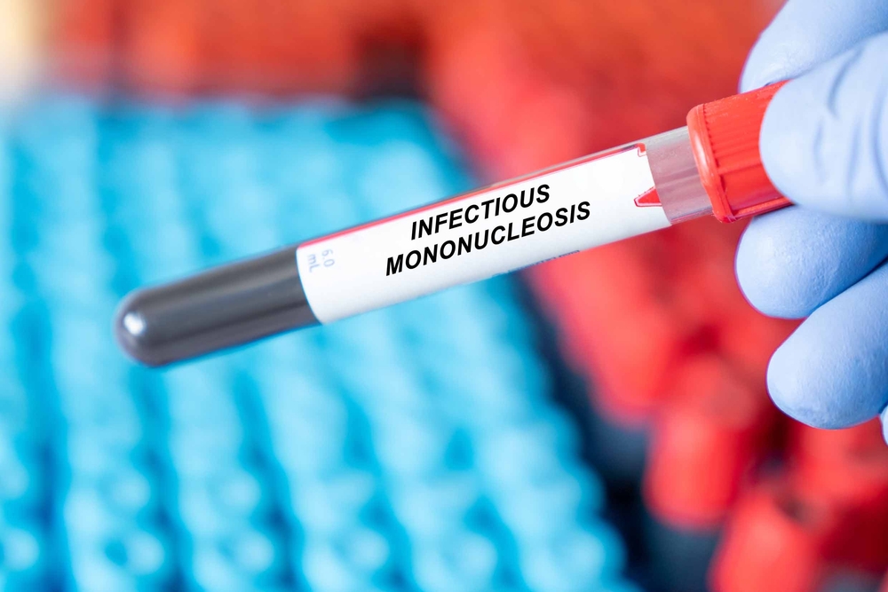 Infectious Mononucleosis