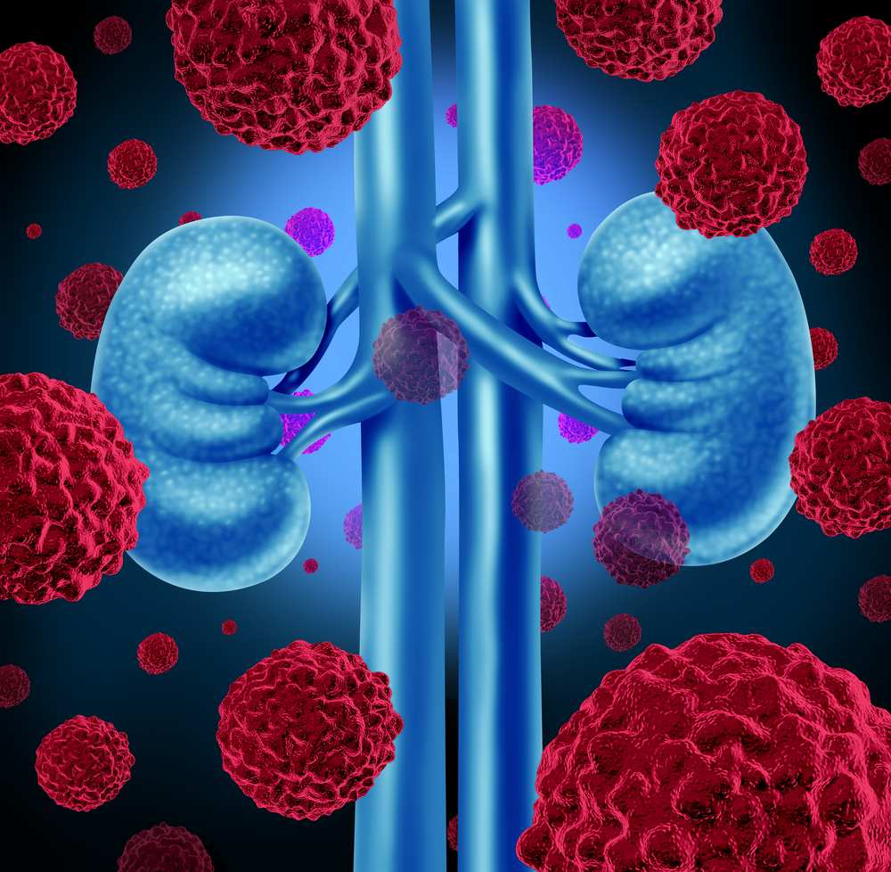  Renal Cell Cancer